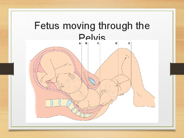 Fetus moving through the Pelvis 