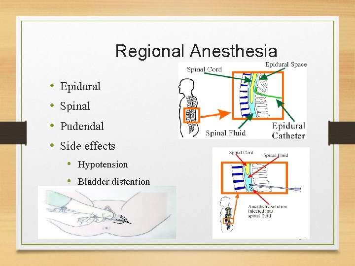 Regional Anesthesia • • Epidural Spinal Pudendal Side effects • Hypotension • Bladder distention
