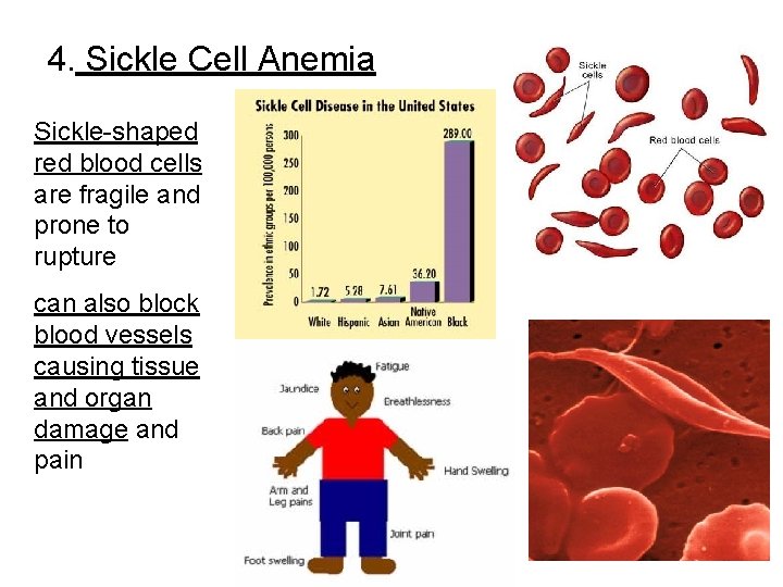 4. Sickle Cell Anemia Sickle-shaped red blood cells are fragile and prone to rupture