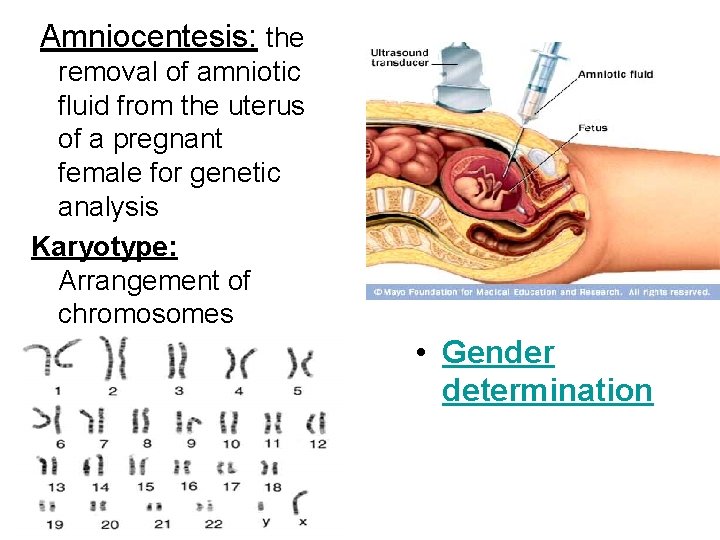 Amniocentesis: the removal of amniotic fluid from the uterus of a pregnant female for