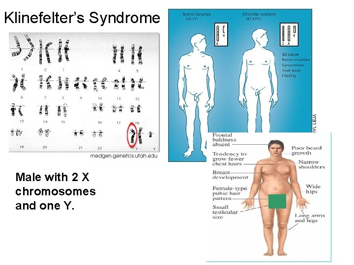 Klinefelter’s Syndrome Male with 2 X chromosomes and one Y. 
