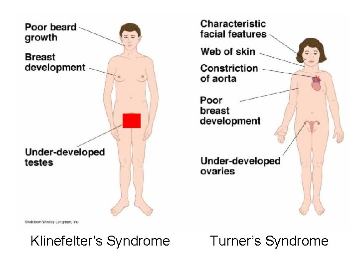 Klinefelter’s Syndrome Turner’s Syndrome 