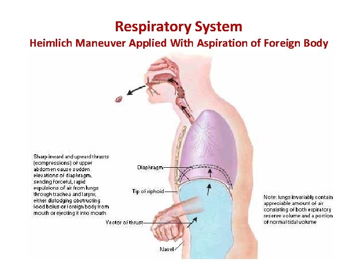 Respiratory System Heimlich Maneuver Applied With Aspiration of Foreign Body 