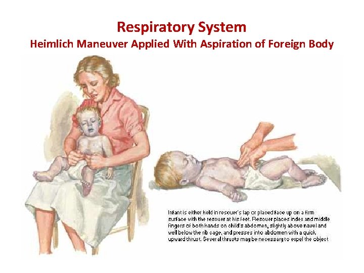 Respiratory System Heimlich Maneuver Applied With Aspiration of Foreign Body 