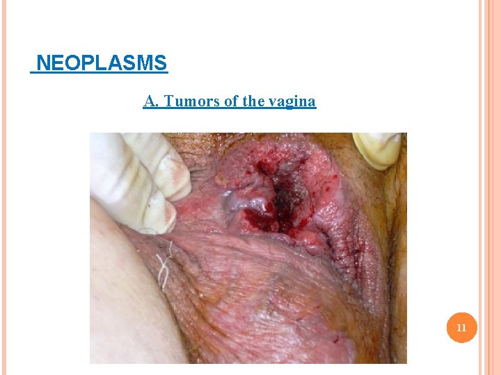 NEOPLASMS A. Tumors of the vagina 11 