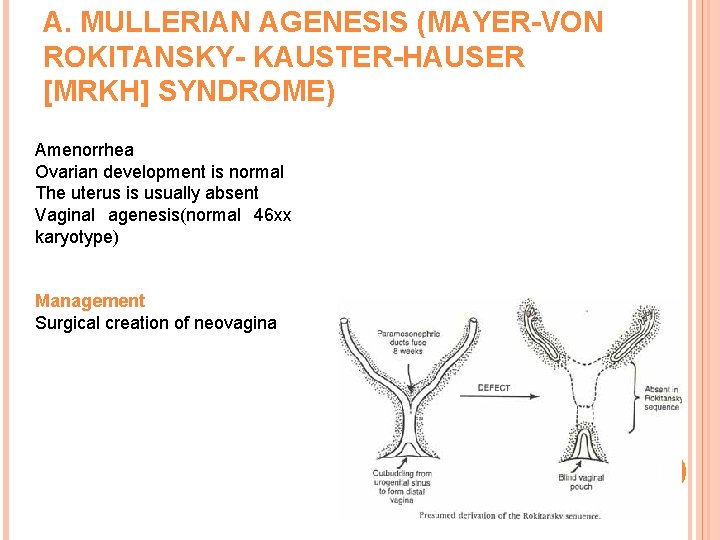 A. MULLERIAN AGENESIS (MAYER-VON ROKITANSKY- KAUSTER-HAUSER [MRKH] SYNDROME) Amenorrhea Ovarian development is normal The