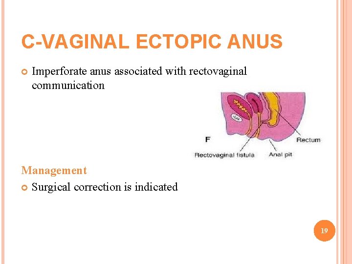 C-VAGINAL ECTOPIC ANUS Imperforate anus associated with rectovaginal communication Management Surgical correction is indicated