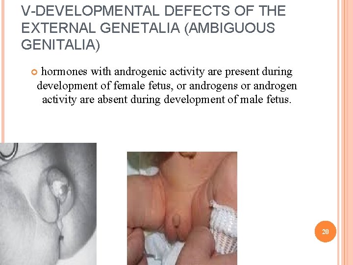 V-DEVELOPMENTAL DEFECTS OF THE EXTERNAL GENETALIA (AMBIGUOUS GENITALIA) hormones with androgenic activity are present