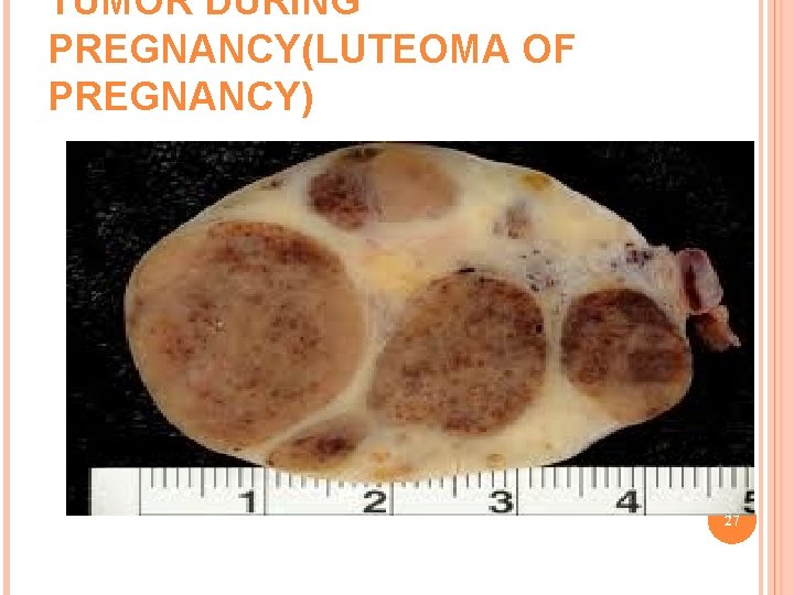 TUMOR DURING PREGNANCY(LUTEOMA OF PREGNANCY) 27 