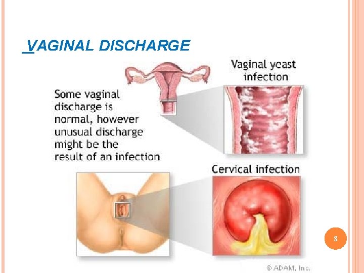 VAGINAL DISCHARGE 8 