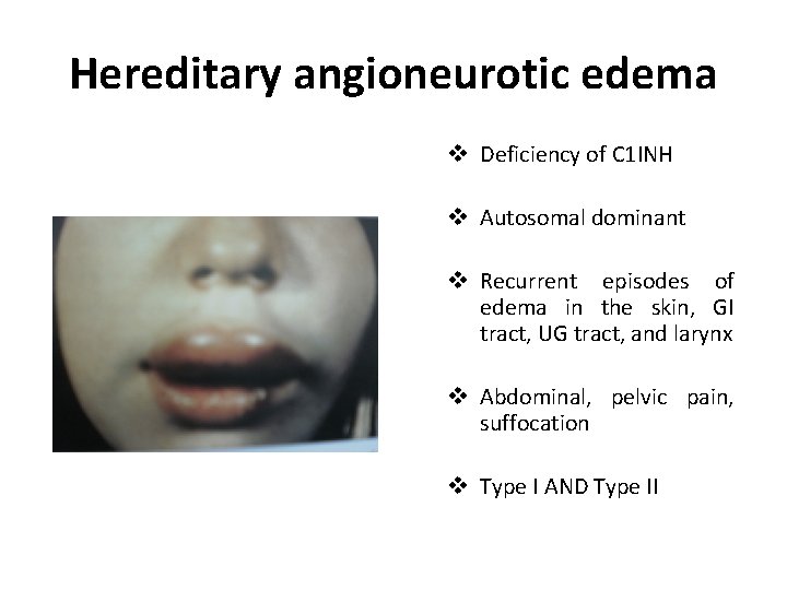 Hereditary angioneurotic edema v Deficiency of C 1 INH v Autosomal dominant v Recurrent