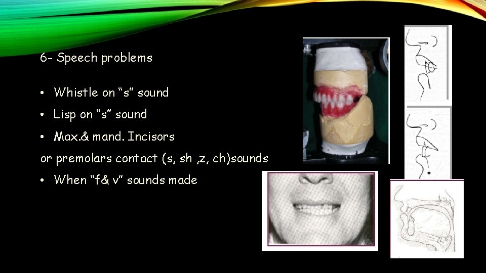 6 - Speech problems • Whistle on “s” sound • Lisp on “s” sound