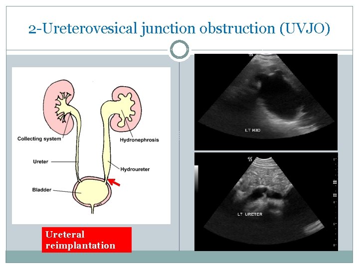 2 -Ureterovesical junction obstruction (UVJO) Ureteral reimplantation 