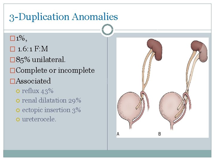 3 -Duplication Anomalies � 1%, � 1. 6: 1 F: M � 85% unilateral.