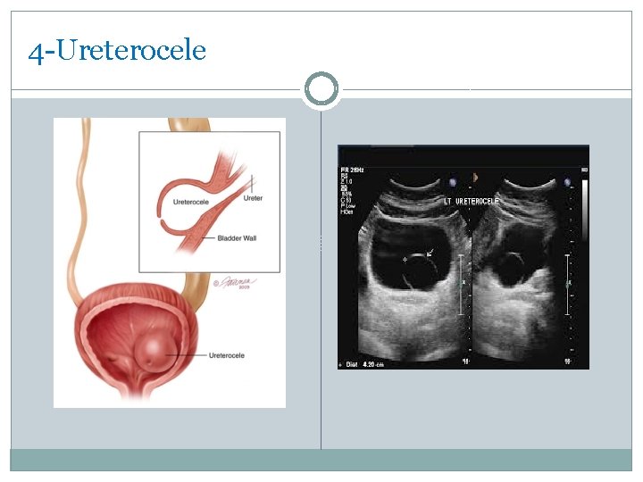 4 -Ureterocele 