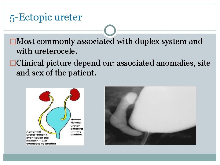 5 -Ectopic ureter �Most commonly associated with duplex system and with ureterocele. �Clinical picture
