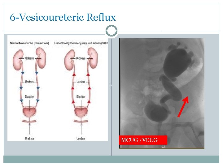 6 -Vesicoureteric Reflux MCUG /VCUG 