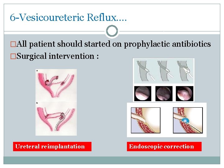 6 -Vesicoureteric Reflux…. �All patient should started on prophylactic antibiotics �Surgical intervention : Ureteral