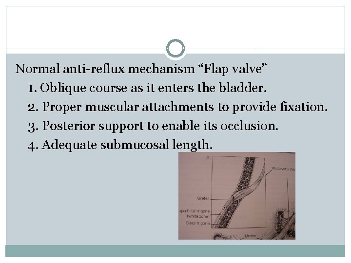 Normal anti-reflux mechanism “Flap valve” 1. Oblique course as it enters the bladder. 2.