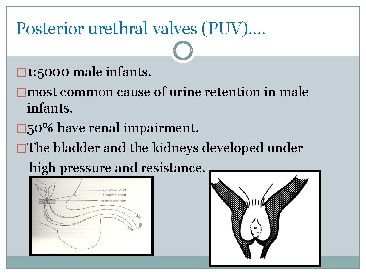 Posterior urethral valves (PUV)…. � 1: 5000 male infants. �most common cause of urine