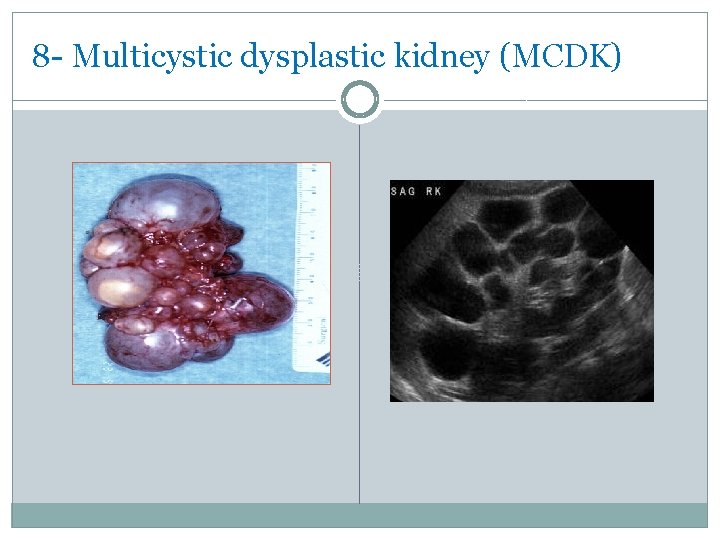 8 - Multicystic dysplastic kidney (MCDK) 