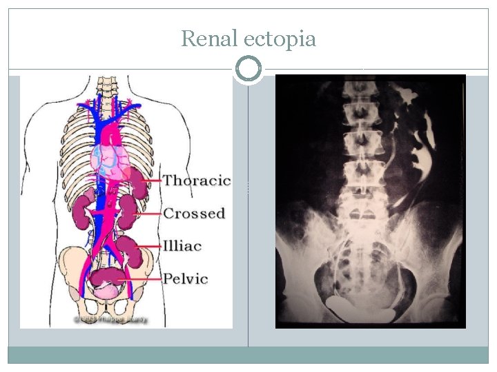 Renal ectopia 