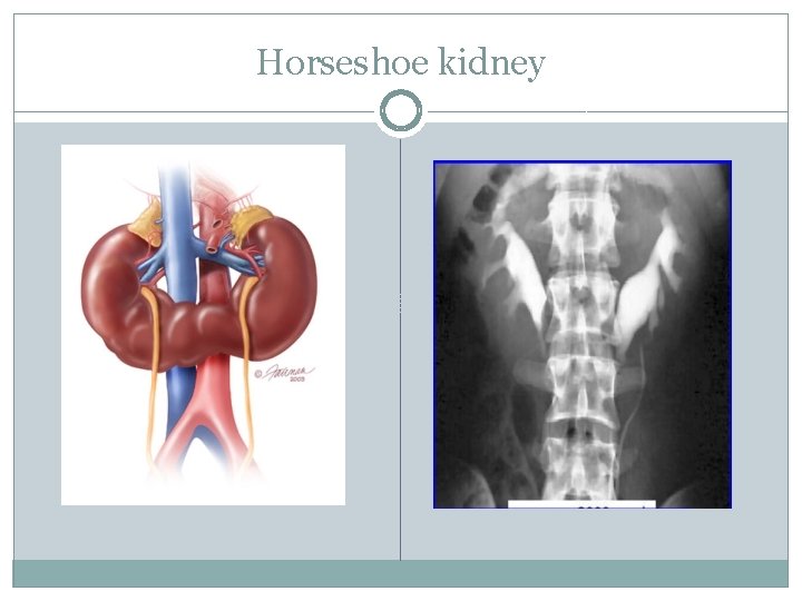 Horseshoe kidney 