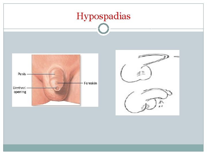 Hypospadias 