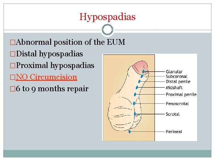 Hypospadias �Abnormal position of the EUM �Distal hypospadias �Proximal hypospadias �NO Circumcision � 6