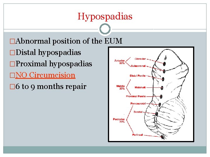 Hypospadias �Abnormal position of the EUM �Distal hypospadias �Proximal hypospadias �NO Circumcision � 6
