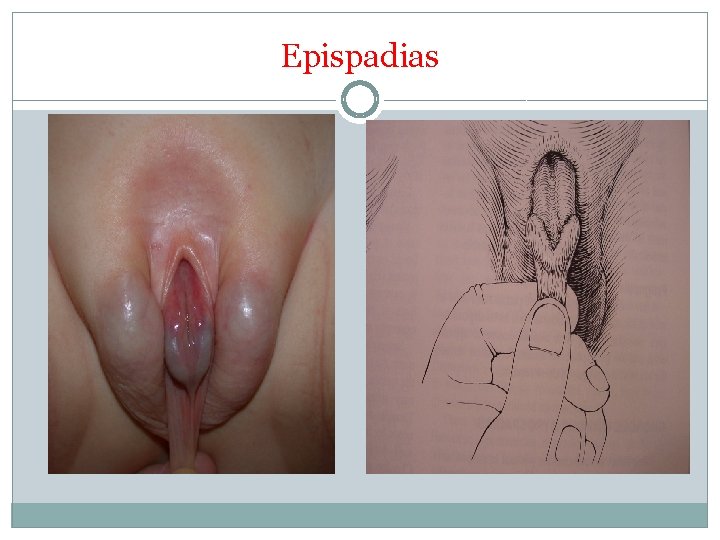 Epispadias 