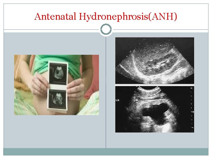 Antenatal Hydronephrosis(ANH) 