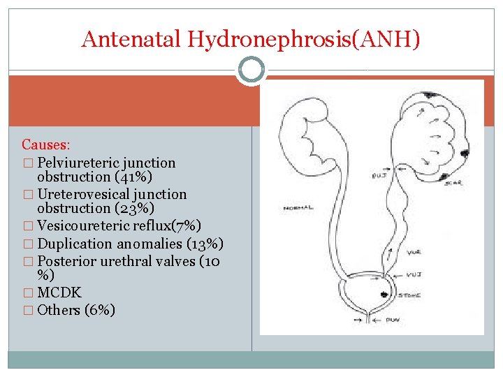 Antenatal Hydronephrosis(ANH) Causes: � Pelviureteric junction obstruction (41%) � Ureterovesical junction obstruction (23%) �