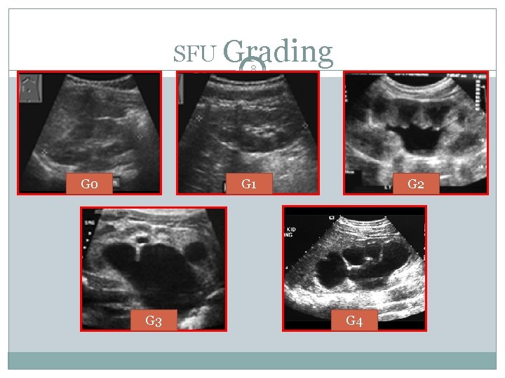 SFU Grading 8 G 0 G 1 G 3 G 2 G 4 