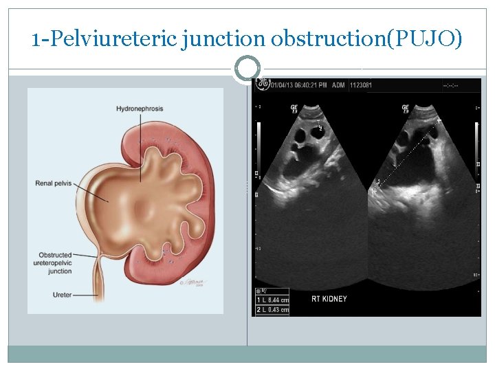 1 -Pelviureteric junction obstruction(PUJO) 