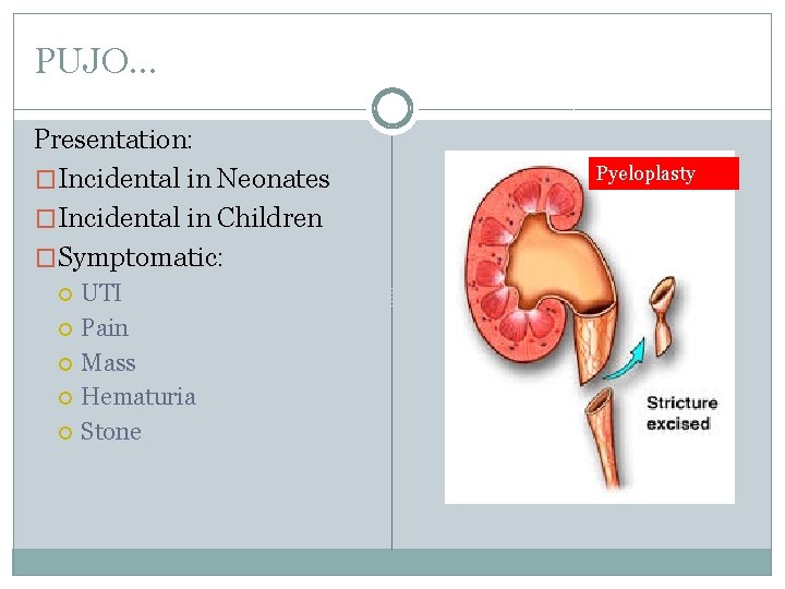 PUJO… Presentation: �Incidental in Neonates �Incidental in Children �Symptomatic: UTI Pain Mass Hematuria Stone