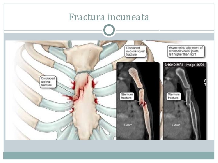 Fractura incuneata 