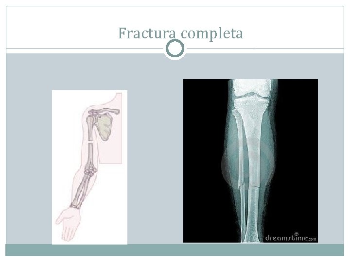 Fractura completa 