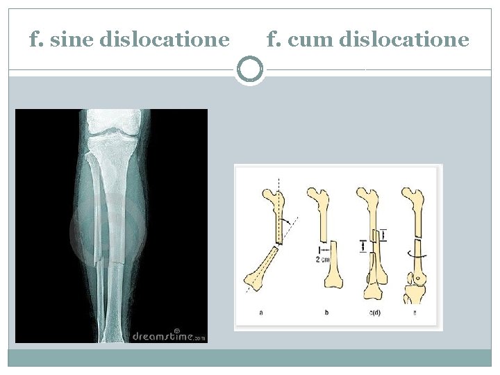 f. sine dislocatione f. cum dislocatione 