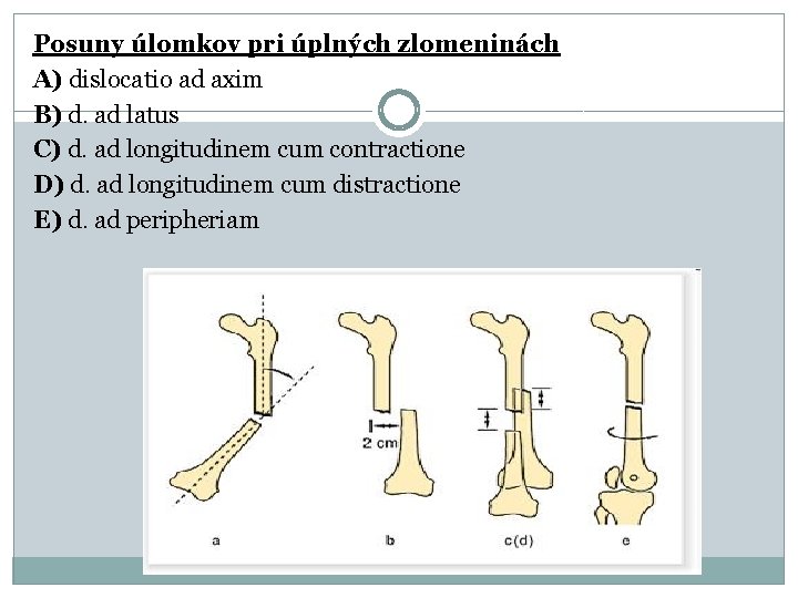 Posuny úlomkov pri úplných zlomeninách A) dislocatio ad axim B) d. ad latus C)