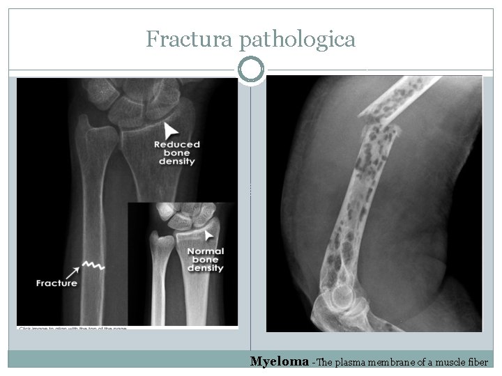 Fractura pathologica Myeloma -The plasma membrane of a muscle fiber 