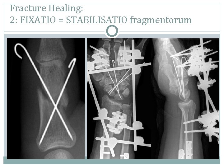 Fracture Healing: 2: FIXATIO = STABILISATIO fragmentorum 