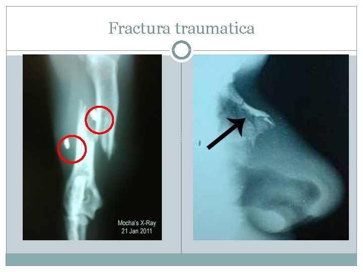 Fractura traumatica 