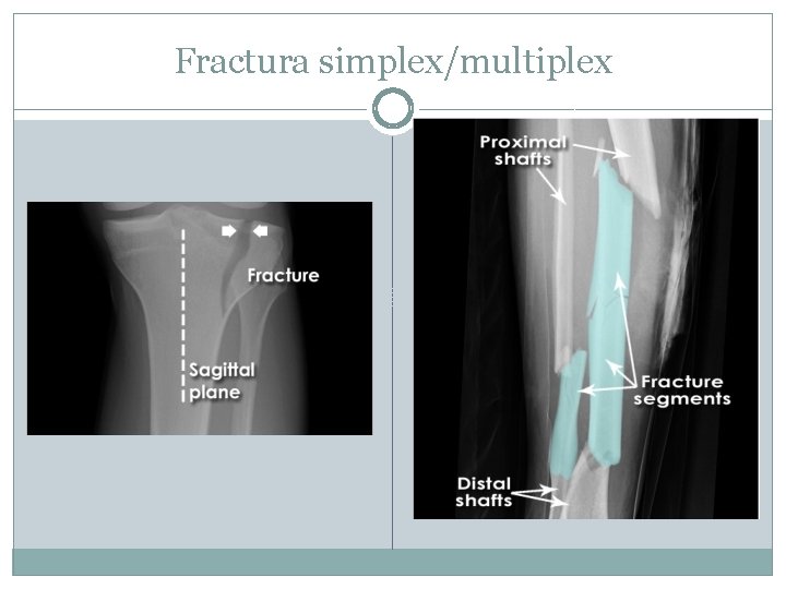 Fractura simplex/multiplex 