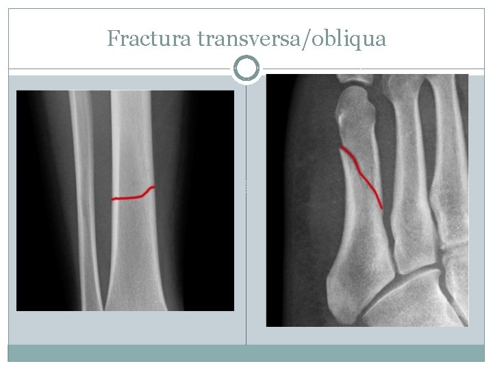 Fractura transversa/obliqua 