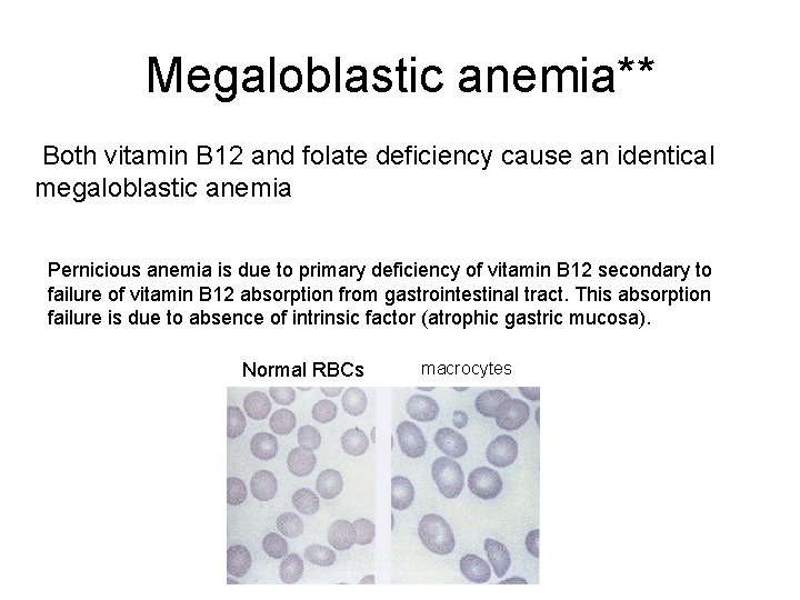 Megaloblastic anemia** Both vitamin B 12 and folate deficiency cause an identical megaloblastic anemia