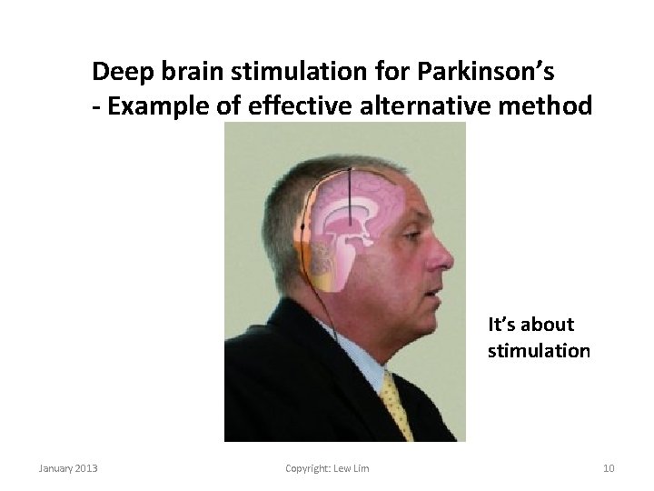 Deep brain stimulation for Parkinson’s - Example of effective alternative method It’s about stimulation