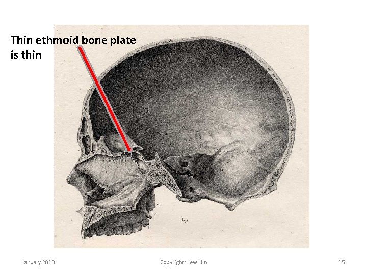 Thin ethmoid bone plate is thin January 2013 Copyright: Lew Lim 15 
