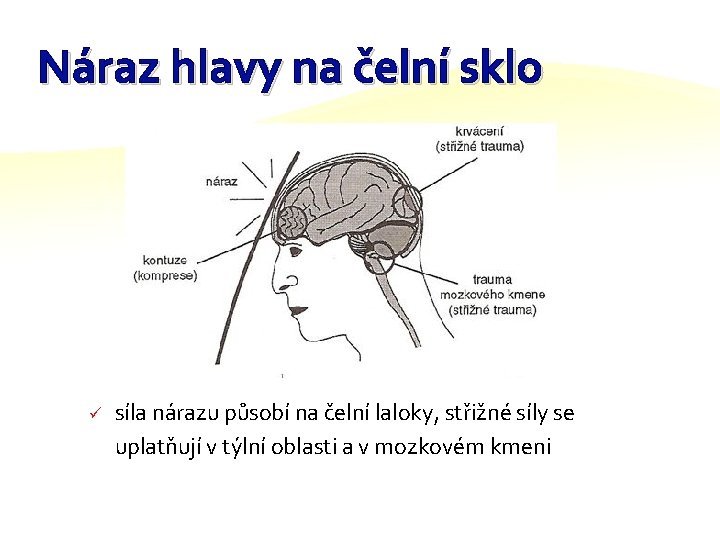 Náraz hlavy na čelní sklo ü síla nárazu působí na čelní laloky, střižné síly