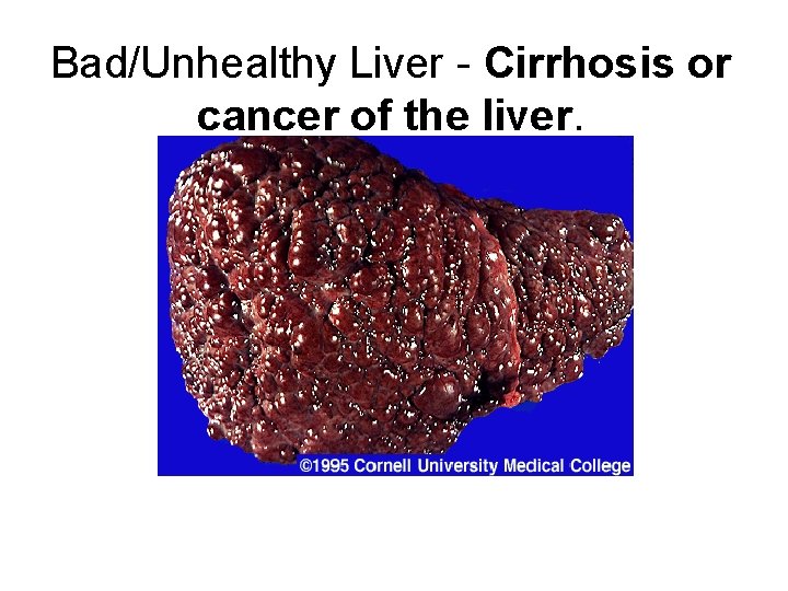 Bad/Unhealthy Liver - Cirrhosis or cancer of the liver. 